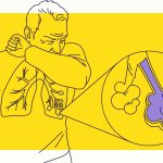 Multifocal Pneumonia