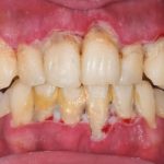 Periodontitis