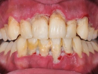 Periodontitis