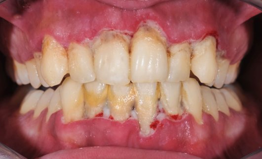 Periodontitis