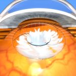 eye floaters after cataract surgery