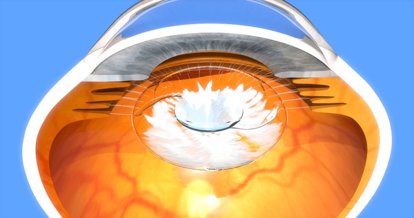 eye floaters after cataract surgery